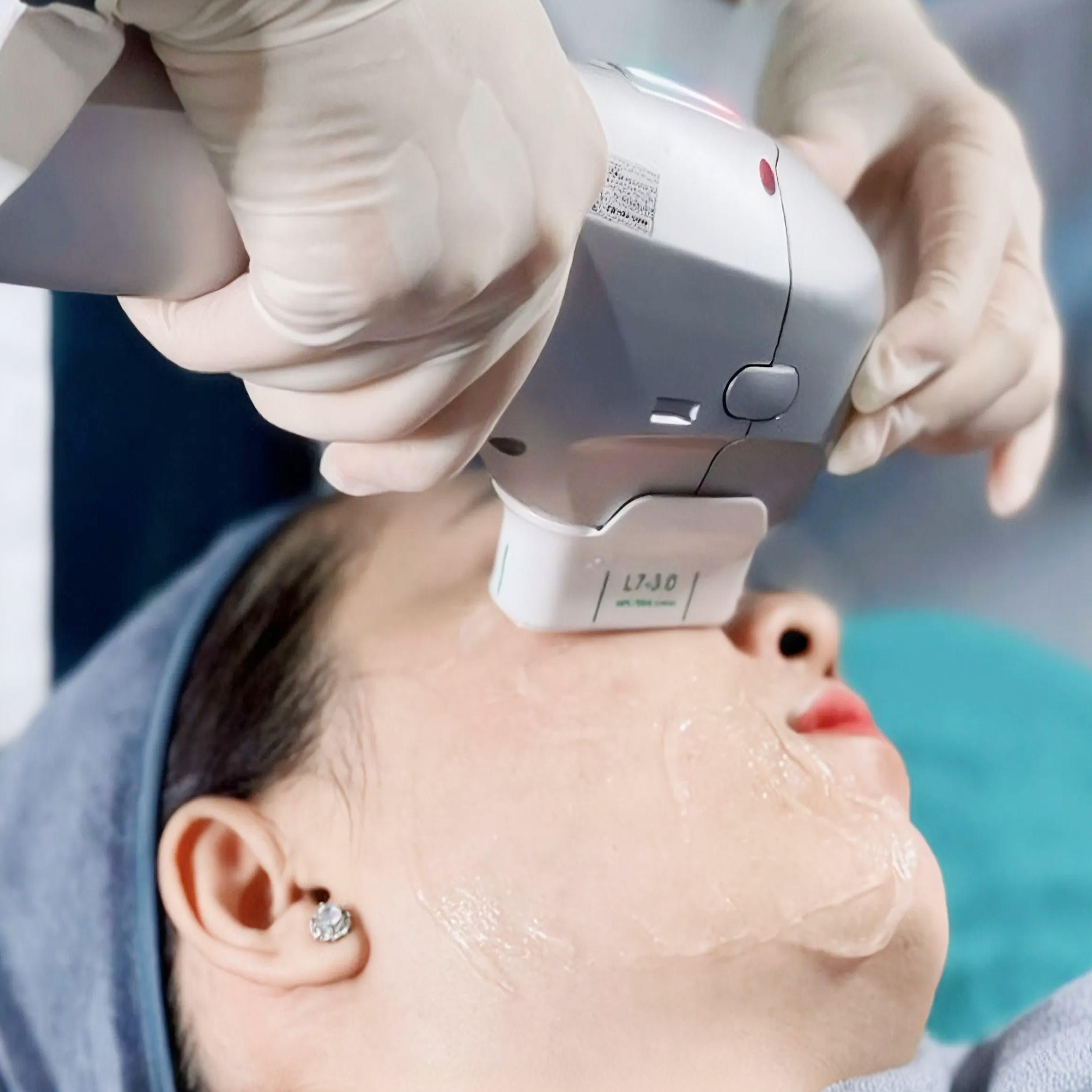 HIFU tại Thẩm mỹ Linh Anh