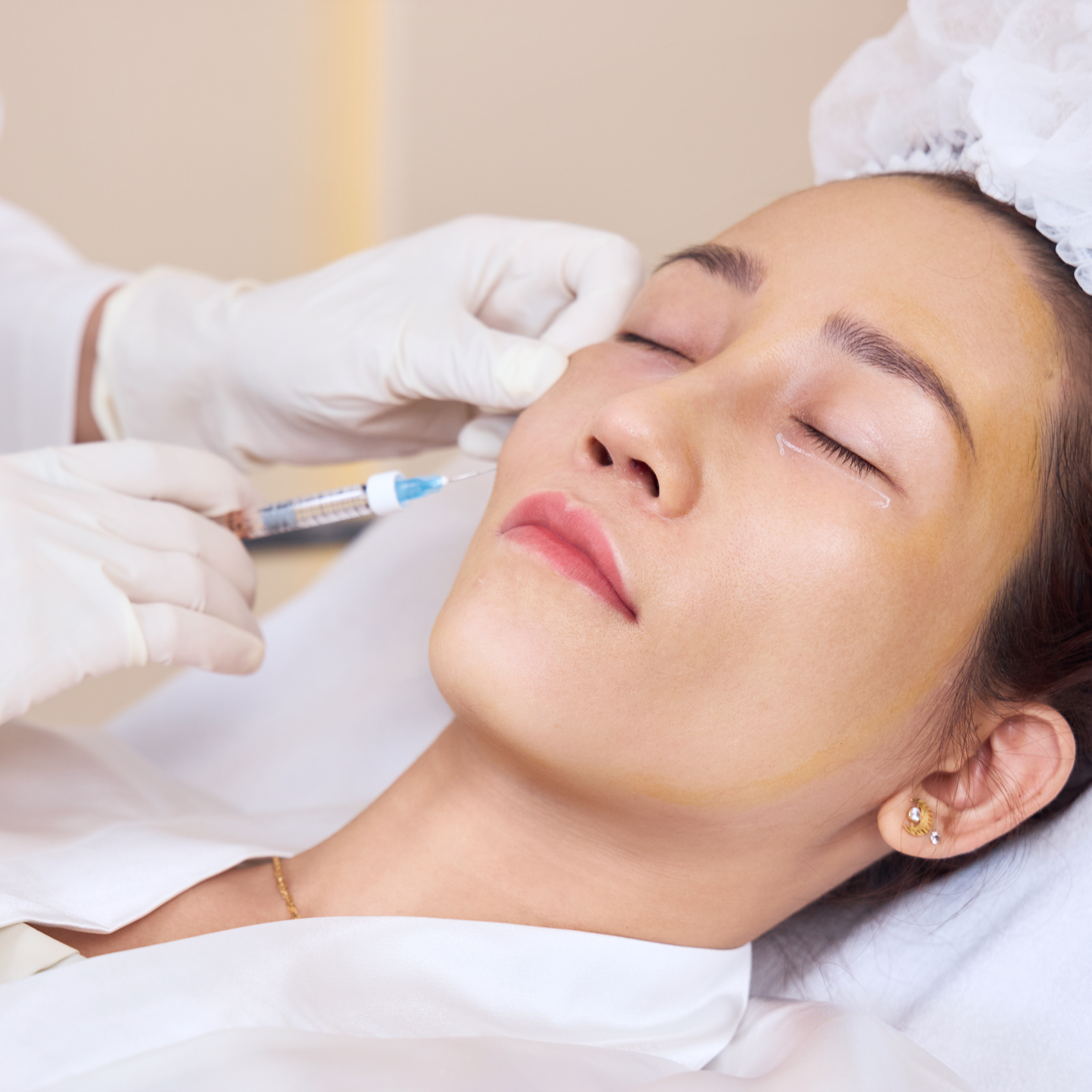 Làm đầy & xóa nhăn tại Thẩm mỹ Linh Anh