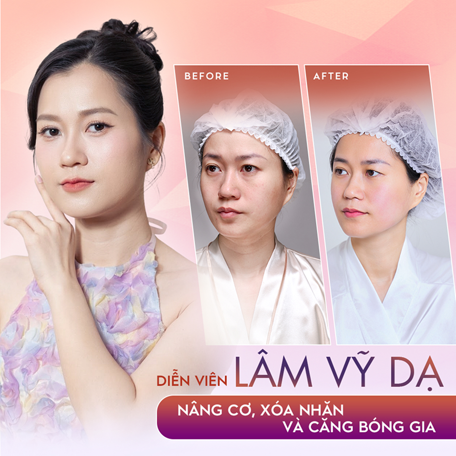 Diễn viên Lâm Vỹ Dạ – Liệu trình trẻ hóa, căng bóng da và cân chỉnh gương mặt tại Thẩm mỹ Linh Anh (ảnh trước và sau)