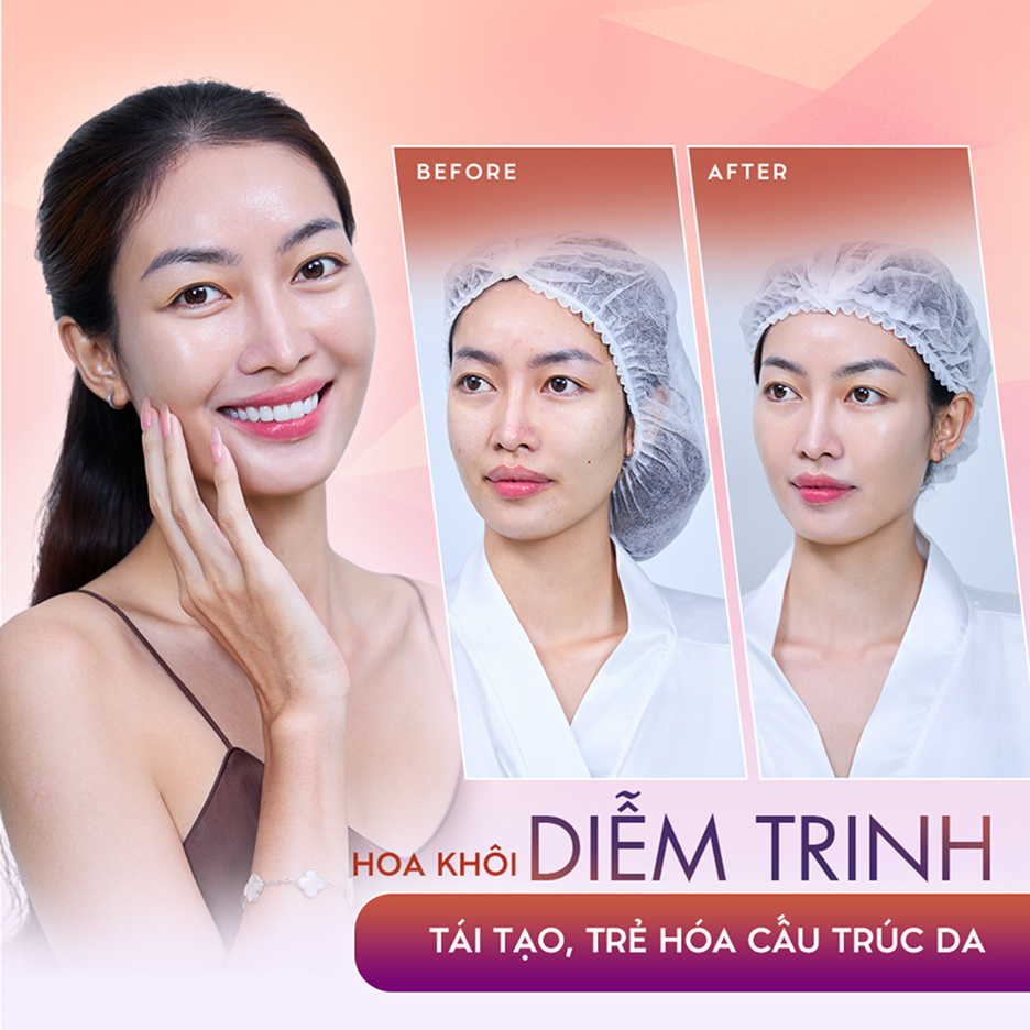 Hoa khôi Diễm Trinh – Liệu trình trẻ hóa, tái tạo nền da tại Thẩm mỹ Linh Anh (ảnh trước và sau)